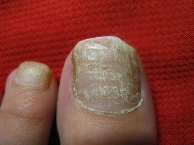 灰指甲的症状表现是怎么样