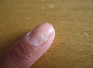 灰指甲的症状表现是什么